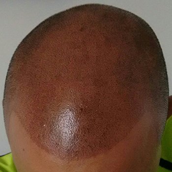 tricopigmentación-350x350